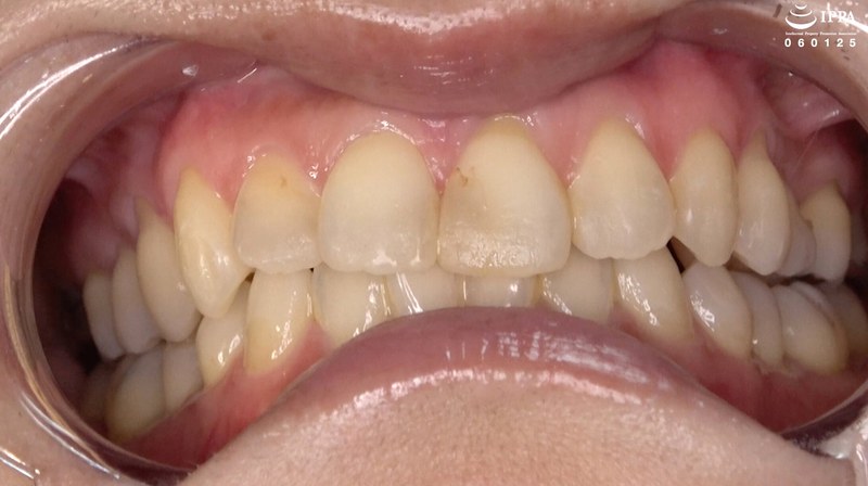 【エロ動画 美少女】【歯・口内フェチ】「素人人妻マナミさんの超貴重な歯＆口内観察！」マナミ